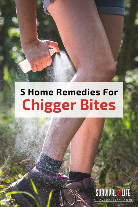 Know these home remedies for chigger bites, or better yet, avoid the bug’s bites in the first place with helpful tips included here! Chiggers Remedy, Chigger Bite Remedy, Home Remedies For Bronchitis, Survival Food Storage, Survival Preparedness, Survival Bag, How To Make Fire, Homemade Products, The Bug