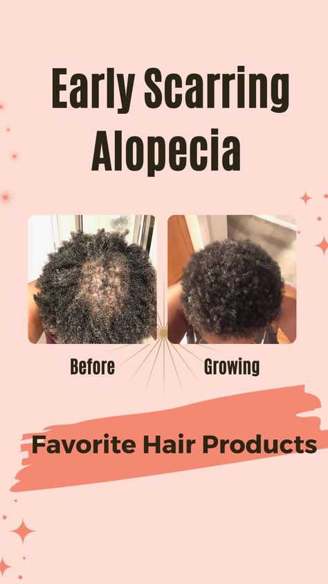 Natural Hair 4c Hairstyles, Hairstyles 4c Natural Hair, Alopecia Hairstyles Black Women, Hair Care 4c, Men Hair Growth, Natural Hairstyles 4c, Scarring Alopecia, Alopecia Hair Growth, Hair 4c Hairstyles