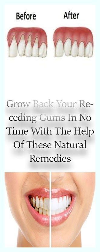 Grow Back Your Receding Gums With The Help Of These Natural Remedies Swollen Gum, Gum Recession, The Teeth, Oral Care Routine, Receding Gums, Gum Health, Dental Problems, Oral Health Care, Garden Tips