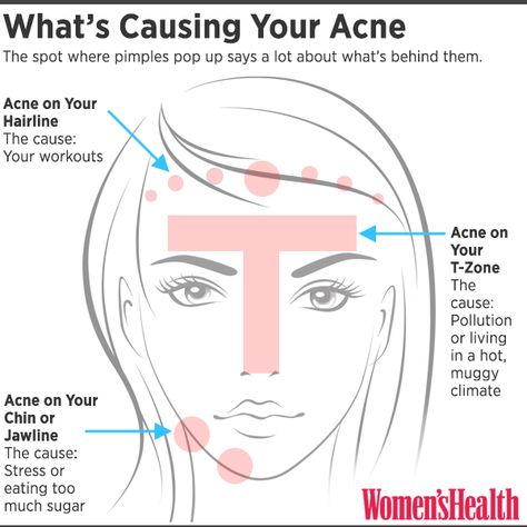 You Can Tell What's Causing Your Acne By Where You Break Out | Women's Health Magazine Korean Beauty Secrets, Prevent Pimples, Natural Acne Remedies, Acne Causes, Acne Scar Removal, Hormonal Acne, Cystic Acne, How To Apply Lipstick, Acne Remedies