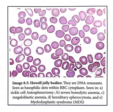 Howell Jolly bodies - Sickle cell Autosplenectomy, Haemolytic anaemia etc ... Laboratory Scientist, Medical Laboratory Scientist, Abnormal Cells, Med Tech, Iron Deficiency, Lab Tech, Laboratory Science, Medical Laboratory, Biology