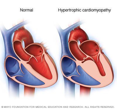 A normal heart (left) and a heart with hypertrophic cardiomyopathy (HCM). Note that the heart walls (muscle) are much thicker (hypertrophied) in the #HCM heart. Muscle Diseases, Enlarged Heart, Normal Heart, Congenital Heart Defect, Heart Rhythms, Heart Muscle, Cardiovascular System, Mayo Clinic, Homeopathy