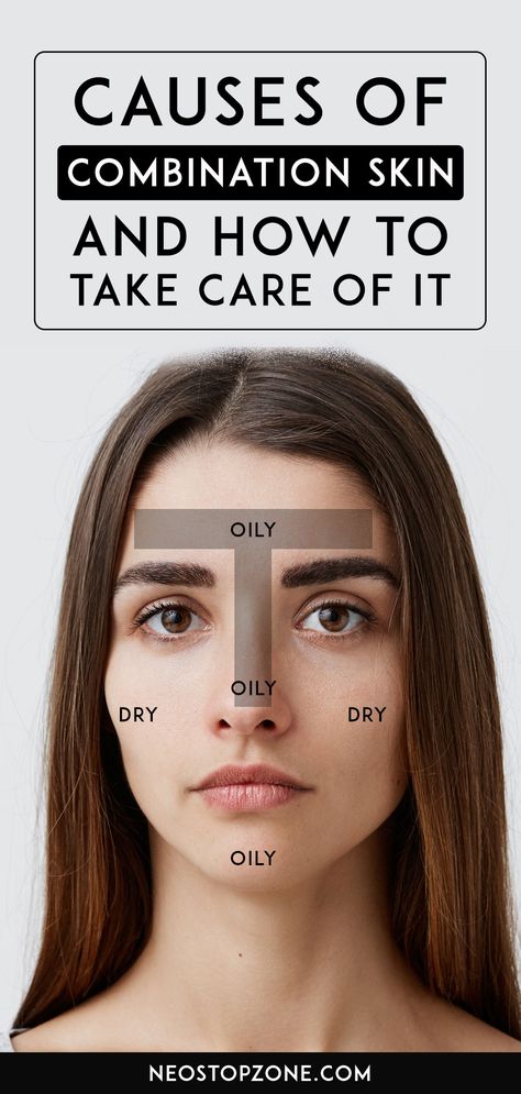 Dry combination skin is characterized by dry cheeks and an oily T-zone. Most of your sebaceous glands are positioned in your T-zone. This primarily means your T-zone produces extra sebum than the rest of your face. When your skin is dry, the sebaceous glands might overproduce oil to keep it hydrated, which will end in a greasy, oily forehead and nose bridge. Nonetheless, your cheeks might stay dry. #skin #skincare #combinationskin Skincare For Bumpy Forehead, Break Out Zones Face, Oily T Zone Skin Care, Acne Zones On Face, Oily Dry Combination Skin, Why Does My Face Get So Oily, Why Is My Face So Oily, Oily Forehead, Oily Nose