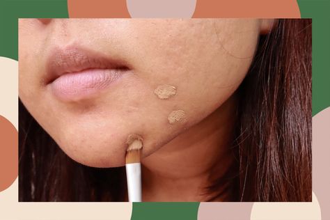 Pimple Coverage Makeup, How To Cover Pimples, White Bumps On Face, Red Spots On Face, Cover Pimples, Cover Up Pimples, Huge Pimple, Inflamed Pimple, Redness Pimple