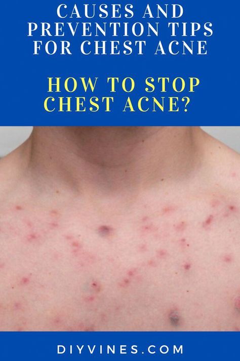 Are you searching for how to stop chest acne? Chest acne can range in appearance from a few red pimples and spots to weeping pustules, blackheads, whiteheads and even cysts. Blackheads On Cheeks, Rash Care, Peroxide For Acne, Redness Pimple, Cystic Acne Remedies, Clear Skin Routine, Chest Acne, Blind Pimple, Get Rid Of Pimples