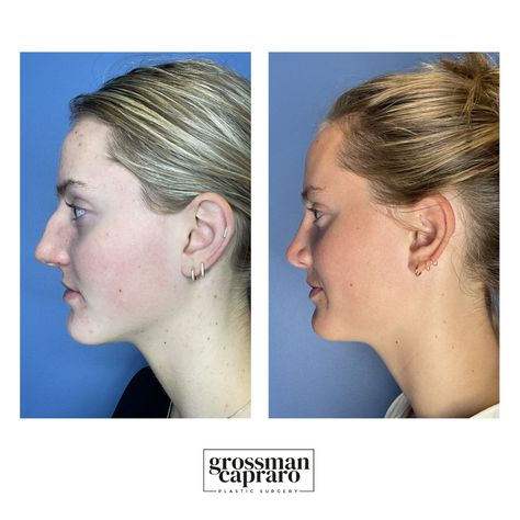 From bump to button 🤩 This #rhinoplasty by @dr.philippeacapraro shows off how natural and proportionate the results of this procedure can be when completed with skill!⁠ ⁠ #GrossmanCapraroPlasticSurgery #rhinoplastybeforeandafter #rhinoplastyexpert #nose #nosejob #nosework #buttonnose #plasticsurgery #denverbeauty #denvercolorado Nose Bump, Button Nose, Nose Work, Plastic Surgery, Bump, Tattoos, Beauty