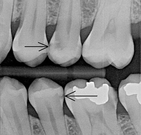 X-ray showing decay due to poor flossing habits. We call these flossing cavities because they would have been prevented if they would have flossed their teeth every day. Teeth Xray, Dental Hygiene Humor, Dental Education, Dental Assisting, Dental World, Dental Tips, Dental Anatomy, Dental Fun, Sedation Dentistry