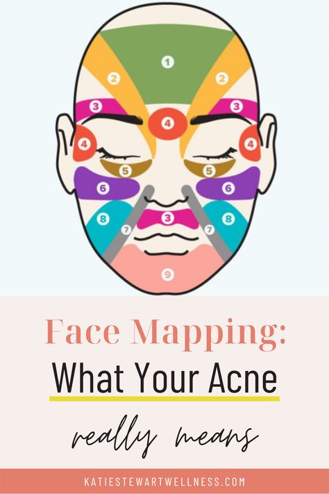 Acne Face Mapping, Chinese Face Map, Acne Chart, Cheek Acne, Face Map, Skin Mapping, Chin Acne, Face Acne Treatment, Acne Tips