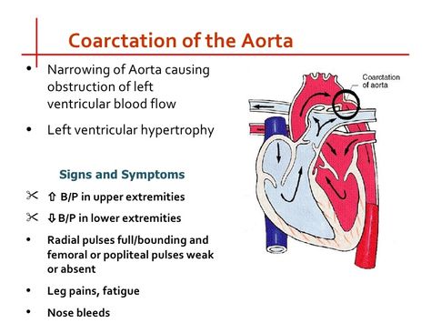 Pediatric Cardiovascular Disorders, Pediatric Cardiology, Coarctation Of The Aorta, Heart Mum, Nclex Review, Cardiovascular Disorders, Nursing Life, Heart Defect, Future Job