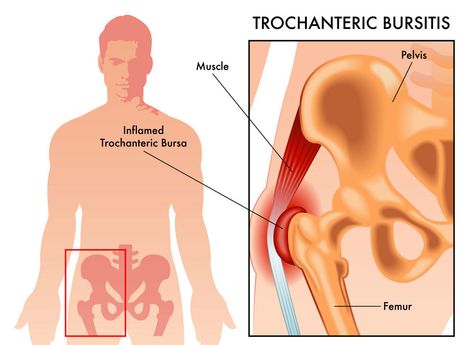 Low Back Pain Stretches, Bursitis Hip Relief, Greater Trochanteric Pain Syndrome, Hip Implants, Best Exercise For Hips, Back Pain Stretches, Bursitis Hip, Hip Pain Relief, Lower Back Pain Relief