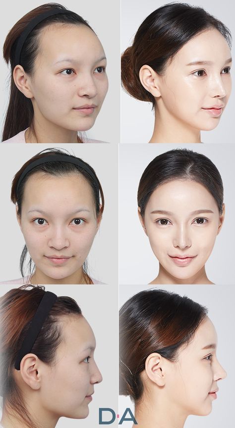 Korean Surgery, Kpop Plastic Surgery, Jaw Reduction Surgery, Face Symmetry, Nose Plastic Surgery, V Line Surgery, Fenugreek For Hair, Plastic Surgery Korea, Plastic Surgery Fail