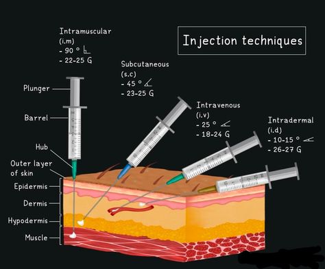 Common injection techniques: 1. Intramuscular (IM): Inject at a 90° angle into muscles using a 22–25 gauge needle, 1–1.5 inches long. 2. Subcutaneous (SC): Inject at a 45–90° angle into fatty tissue with a 25–27 gauge needle, 3/8–5/8 inch. 3. Intradermal (ID): Inject at a 5–15° angle into the skin’s surface using a 26–27 gauge needle, 3/8–1/2 inch. 4. Intravenous (IV): Insert at a 15–30° angle into a vein with a 20–22 gauge needle for adults. Injection Needle, Im Injection, Layers Of Skin, The Skin, Muscles, Medical, Skin