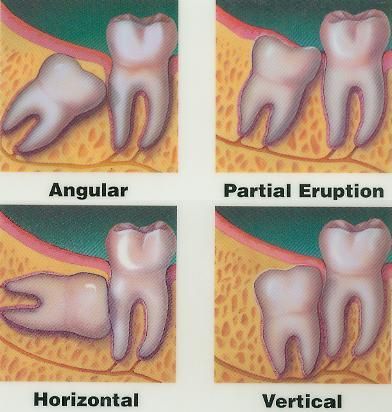 Embedded And Impacted Teeth | HubPages Wisdom Teeth Swelling, Wisdom Teeth Recovery, Impacted Wisdom Teeth, Wisdom Teeth Pain, After Wisdom Teeth Removal, Teeth Surgery, Impacted Tooth, Wisdom Tooth, Wisdom Tooth Extraction