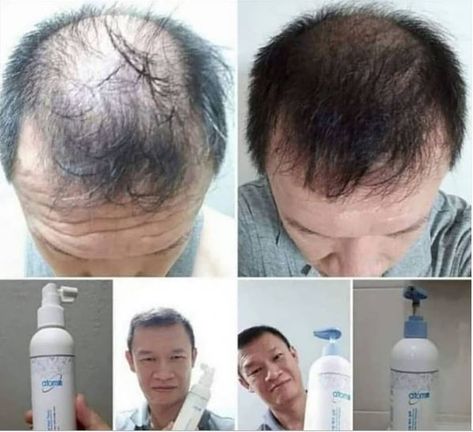 No More Hair Loss With Atomy Shampoo #atomy #shampoo #bald #hair Atomy Products, Oils For Hair, Essential Oils For Hair, Health And Beauty Products, Hair Tonic, Korean Skin Care, Korean Skin, Healthy Hair Growth, Car Racing