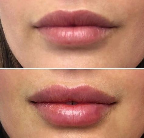 Dermal Fillers Lips, Facial Procedure, Lips Inspiration, Botox Lips, Facial Fillers, From Rags To Riches, Rags To Riches, Perfect Eyelashes, Facial Aesthetics