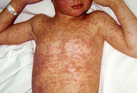 Pictures of Viral Skin Diseases and Problems - Herpetic Whitlow Skin Diseases Pictures, Yeast Infection Pictures, Skin Disease Pictures, Diseases Pictures, Itchy Rash, Viral Infection, Body Healing, Medical Practice, Skin Diseases