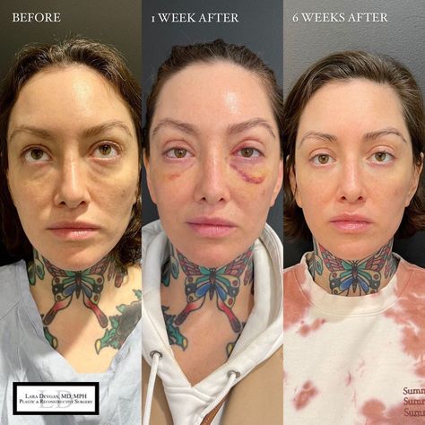 Dr. Lara Devgan, MD, MPH, FACS on Instagram: “Finesse eyelid surgery for the beautiful @erinparsonsmakeup 📐📐📐 Most of my high-profile patients don't share their surgical procedures…” Kpop Plastic Surgery, Jaw Reduction Surgery, Change Appearance, V Line Surgery, Plastic Surgery Fail, Korean Plastic Surgery, Face Surgery, Plastic Surgery Gone Wrong, Cheek Fillers