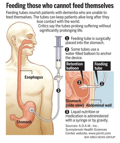 What Do Dementia Patients Die From Check more at http://www.nhprimecare.org/what-do-dementia-patients-die-from/ Peg Tube Feeding, Veggie Beds, Gastrostomy Tube, Anatomy Education, Exercise Abdomen, Peg Tube, Tube Feeding, Physical And Chemical Properties, Nursing School Tips