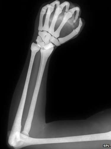 X-ray of clenched fist Hand Structure, Evolution Of Human, Skeleton Arm, Clenched Fist, Human Hand, Doja Cat, Bbc News, Drawing Inspiration, Face Masks