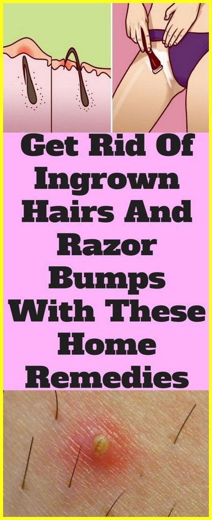 GREAT TRICK WITH WHICH YOU WILL NO LONGER HAVE INGROWN HAIRS AFTER SHAVING Get Rid Of Ingrown Hairs, Infected Ingrown Hair, Remove Skin Tags Naturally, Home Medicine, Ingrown Hairs, Razor Bumps, Unwanted Hair Removal, Unwanted Hair, Ingrown Hair