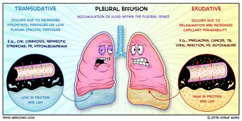 Pleural Effusion Respiratory Therapy Student, Emt Study, Medical Mnemonics, Pleural Effusion, Studying Medicine, Nursing Mnemonics, Nursing Student Tips, Pharmacology Nursing, Pulmonology