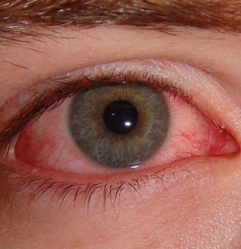 Pink Eye In Kids, How To Get Rid Of Pink Eye Fast, Crusty Eyelashes, Blocked Tear Duct, Upper Respiratory Infection, Eye Infections, Old Makeup, Pink Eye, Itchy Eyes