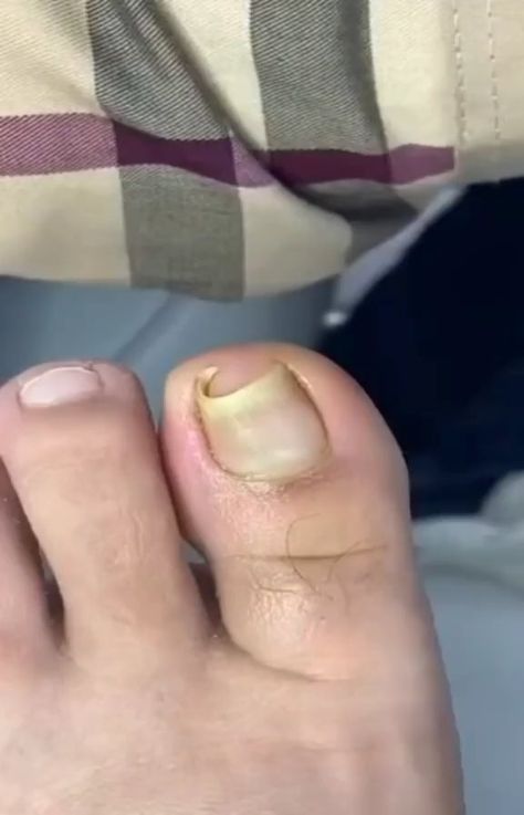 Toe Nail Cleaning, Ingrowing Toenail, Ingrown Nail Removal, Infected Toenail, Toenail Removal, Nail Problems, Cleaning Videos, Ingrown Nail, Ingrown Toe Nail