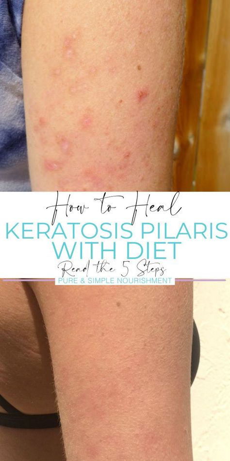 Kerotisis Pilaris, Kp Skin Remedies, Chicken Skin Remedy, Keratosis Pilaris On Face, Kp Skin, Pilaris Keratosis, Keratosis Pilaris Remedy, Diet Changes, Home Remedies For Skin