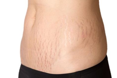 Why You Should Use a Stretch Marks Cream During Pregnancy@DelicateMl #blogengage Abdominal Stretches, Stretch Mark Removal Cream, Marks Cream, Ib Art, Face Care Routine, Stretch Mark Removal, Stretch Mark Cream, Stretch Mark, Luxury Cosmetics