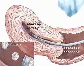 Dr.Malpani's Blog: Will my embryo fall out after the embryo transfer ?------Interesting...being that I have been on bed rest all day.... Ivf Timeline, Child Support Quotes, Embryo Implantation, Child Support Laws, Ivf Quotes, Ivf Pregnancy Announcement, Frozen Embryo Transfer, Embryo Adoption, Child Support Payments