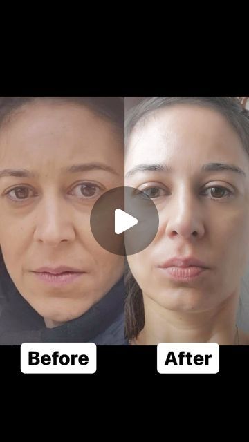 FACE WORKOUT  by Mia on Instagram: "Yes, it’s possible with FACE WORKOUT - with a structured schedule for your face and neck.

Why FACE WORKOUT?

✔️ Customizable routines to suit your SKIN needs.
✔️ Suitable for ALL SKIN TYPES, ages and fitness levels.
✔️ Quick and convenient, it can be done anytime, anywhere.
✔️ Enhances the benefits of skincare products when incorporated into a daily routine.
✔️ Helps maintain youthful, glowing and healthy skin at any age.

This is for you if you have:

❌ Dark circles 

❌ Dull dry skin

❌ Double chin

❌ Face puffiness

❌ Frown lines

❌ Smile lines

❌ Neck wrinkles 

Join QUICK FACELIFT 3 months membership and tone facial MUSCLES to widen eyes, raise cheeks and firm up the jawline.

 Join here:
🔹Faceworkoutbymia.com🔹

Link is in the BIO [description of Face Puffiness, Face Workout, Frown Lines, A Daily Routine, Neck Wrinkles, Smile Lines, Crepey Skin, Facial Muscles, Double Chin