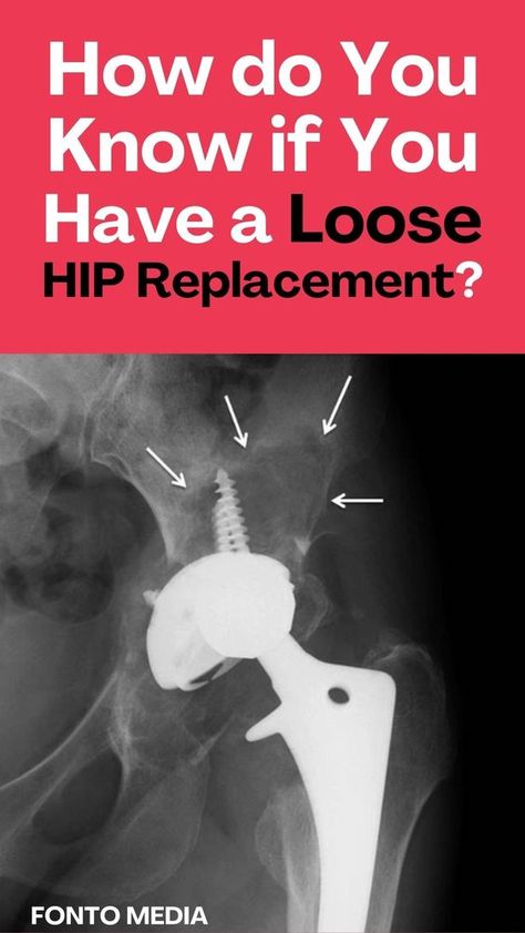 Do you suspect loosening of your total or partial hip joint replacement due to pain or other symptoms? Or have you been diagnosed with loosening, and you’re worried and filled with questions about what will happen? As a physical therapist, I’m accustomed to seeing people in this situation. Hip Surgery Recovery, Bursitis Hip, Hip Problems, Hip Surgery, Physical Therapy Exercises, Spine Surgery, Bone Loss, Surgery Recovery, Hip Pain