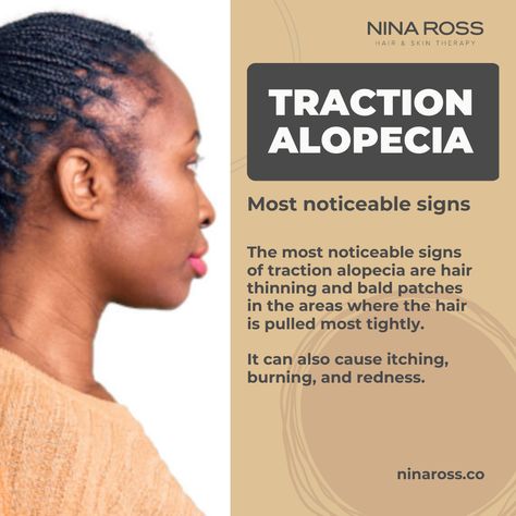 Traction alopecia is a type of hair loss that is caused by excessive styling or pulling of the hair. It is most common among people who wear tight hairstyles such as braids, cornrows, ponytails, and dreadlocks. 💇🏾♀️ If you are experiencing hair loss due to traction alopecia hairstyles, it is important to stop styling your hair in a way that pulls on the roots. This will help prevent further hair loss.🤔 💎 Visit our website and discover all the solutions for hair loss: ninaross.co Traction Alopecia Regrowth, Traction Alopecia Hairstyles, Alopecia Awareness, Alopecia Hairstyles, Traction Alopecia, Braids Cornrows, Bald Patches, Hair Growth Cycle, Hair School