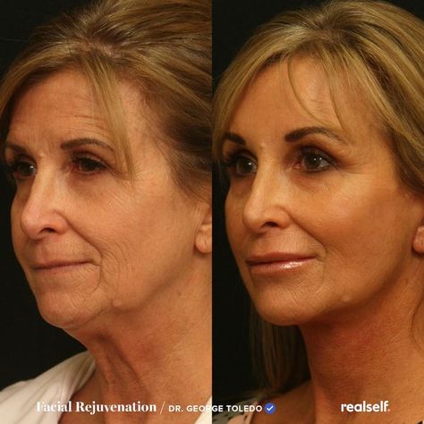 Neck Tightening Procedures, Facial Fat Grafting, Fat Grafting Face, Face Plastic Surgery, Neck Lift Surgery, Mini Face Lift, Facial Procedure, Face Surgery, Face Lift Surgery