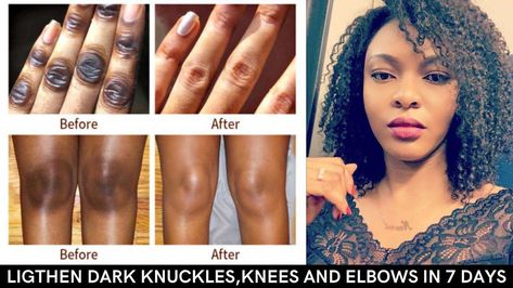 Hello loves, in this video i shared the secret on clearing and lightening your dark knuckles,dark kness or dark elbows with just home remedies. You can light... Dark Knuckles, Dark Elbows, Dark Underarms, Can Light, Glo Up, Health Planner, Health Fitness Motivation, Back Pain Exercises, Workout Pictures