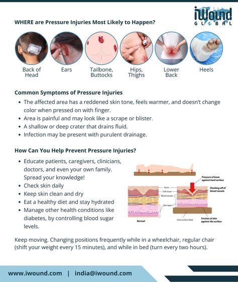 Understanding Pressure Injuries Pressure injuries, commonly known as pressure ulcers or bedsores, are localized damage to the skin and underlying tissue caused by prolonged pressure. Here are some essential facts: 1️⃣ At-Risk Populations: Individuals with limited mobility, such as the elderly, those with spinal cord injuries, or patients in long-term care settings, are particularly at risk. 2️⃣ Stages of Pressure Injuries: These injuries are classified into four stages, ranging from stage ... Pressure Ulcer Staging, Pressure Injury, Spinal Cord Injuries, Pressure Ulcer, Spinal Cord, Can You Help, Long Term Care, Caregiver, Skin Tones