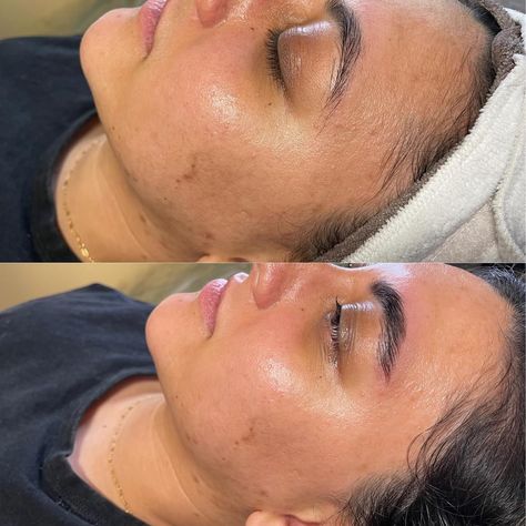 My beautiful client got a dermaplane facial, lash lift, and brow lam & tint! The before and afters really show how dermaplaning exfoliates the top layer of skin to reveal the glow from underneath! You can also see the texture change from before and after on the forehead and cheeks to a smooth finish! #esthetician #dermaplaning #estheticianlife #dermaplaningfacial #glowfacial #laslifting #browlamination #browshaping #browlift #browlam Dermaplane Facial Before And After, Facial Dermaplaning, Dermaplaning Before And After, Hydrafacial Before And After, Dermaplaning Facial, What Is Dermaplaning, At Home Dermaplaning, At Home Dermaplaning Facial, Facial Before And After