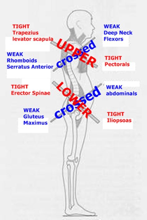 Upper Cross Syndrome, Punkty Spustowe, Physical Therapy Assistant, Sports Therapy, Muscle Imbalance, Muscle Anatomy, Sports Massage, Medical Anatomy, Hip Flexor