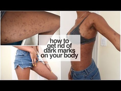 HOW TO GET RID OF DARK SPOTS ON LEGS & BODY FAST | GET CLEAR EVEN SKIN TONE ALL OVER! - YouTube Clear Even Skin, Dark Spots Under Eyes, Dark Spots On Legs, Getting Rid Of Scars, Dark Spot Remover, Spots On Legs, Dark Spots On Face, Spot Remover, Beach Blonde