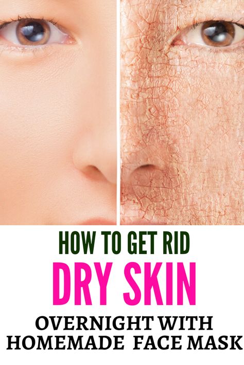 How to get rid dry skin with home remedies overnight Winter Skin Care For Dry Skin, Remedy For Dry Skin On Face, Remedies For Dry Skin On Face, Dry Face Skin Remedies, How To Fix Dry Skin On Face, Dry Face Remedy Diy, Skin Hydration Skincare, Home Remedy For Dry Skin On Face, Natural Remedies For Dry Skin