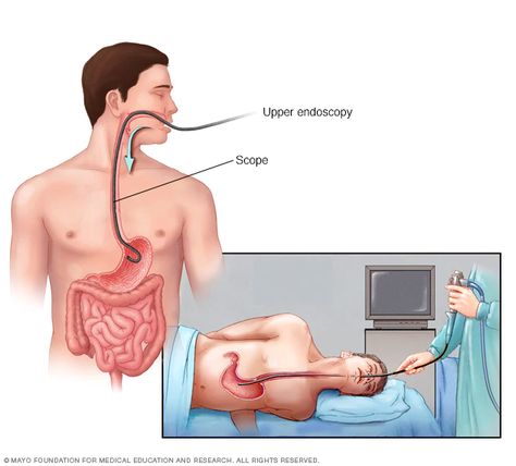 Esophageal Spasm, Ulcer Symptoms, Esophageal Varices, Tiny Camera, Muscle Twitching, Small Intestine, Reflux Disease, Stomach Ulcers, Alternative Treatments