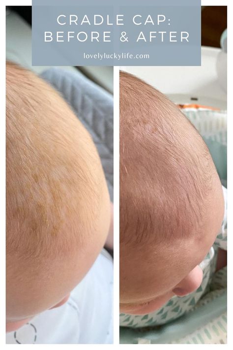 Cradle Cap Remedies, Baby Cradle Cap, Baby Acne, Hydrocortisone Cream, Scalp Brushing, Cradle Cap, Regrow Hair, Baby Care Tips, Flaky Skin