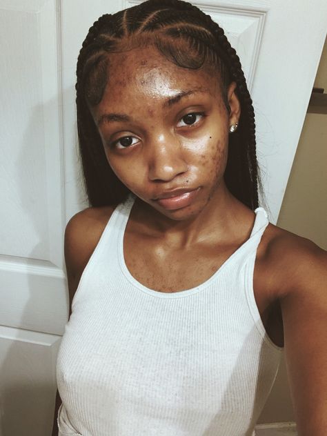 Face Birthmark Aesthetic, Acne Appreciation Aesthetic, Acne Black Women, Bare Face Beauty, Normalize Acne, Girls With Acne, Pretty People With Acne, Acne Girl, Women With Acne