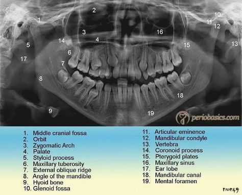 59 Likes, 5 Comments - Howard Farran (@howardfarran) on Instagram: “Anatomical landmarks on a Panoramic radiograph. Dentaltown Oral and Maxillofacial Radiology…” Hygienist Humor, Dental Xrays, Dental Radiology, Panoramic Radiograph, Dental Assistant Study Guide, Dental Infographics, Surgeon Quotes, Dental Hygienist School, Teeth Funny