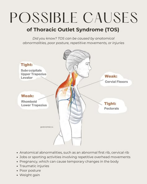 Feeling discomfort in your neck, shoulders, or arms? It could be Thoracic Outlet Syndrome (TOS) 🧨💥 Discover how chiropractic care can help alleviate symptoms and improve your quality of life. From spinal adjustments to postural education, we’ve got you covered 😌🫱🏽‍🫲🏾 SWIPE through to learn more ➡️ ! ____________________________________________ Thoracic Outlet, Thoracic Outlet Symptoms, Muscles Of The Neck Anatomy, Levator Scapulae Muscle, Message Therapy, Upper Cervical Chiropractic, Muscles Of The Neck, Physical Therapy Student, Neck And Shoulder Muscles