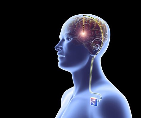 Brain Implants Market Set to take Giant Positive Leap Vagus Nerve Stimulator, Spinal Cord Stimulator, Pestel Analysis, Essential Tremors, Deep Brain Stimulation, Peer Group, Brain Stimulation, Market Segmentation, Core Competencies