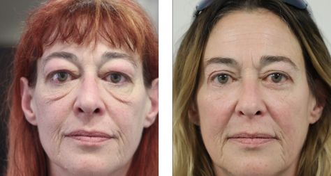 Blethoplasty Before And After, Lower Blephoraplasty Before And After, Upper Blephoraplasty Before And After, Blephoraplasty Before And After, Eye Lift Surgery, Remove Eye Bags, Eye Lift, Tired Eyes, Before And After Pictures