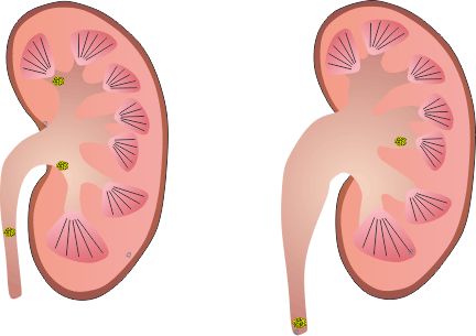 Esta es la terminología médica, junto con los cálculos renales, Que se utiliza en el sentido de cálculos renales. La formación de cálculos renales en las personas es bastante alto. Puede ser tan alto como diez personas por cada cien personas. Read More