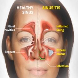 Remedy For Sinus Congestion, Sinus Remedies, Home Remedies For Sinus, Sinus Infection Remedies, Allergy Remedies, Sinus Congestion, Sinus Infection, Vitamin D3, Natural Home Remedies