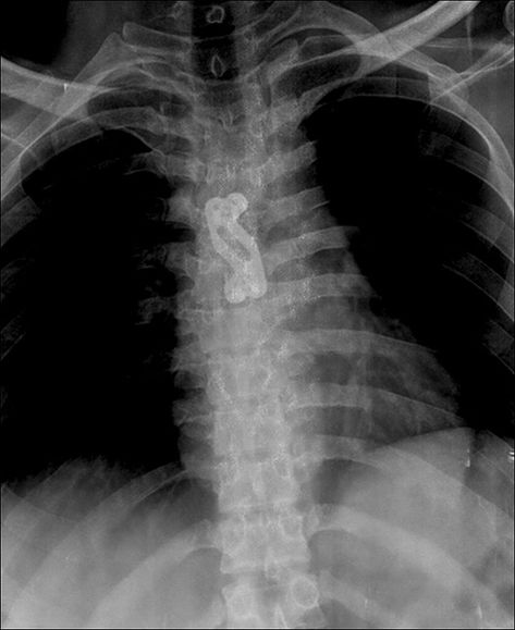 Iliac Crest, Cancellous Bone, Vascular Surgery, Mri Scan, Activities Of Daily Living, Coronary Arteries, Ct Scan, Chest Pain, Pain Relief